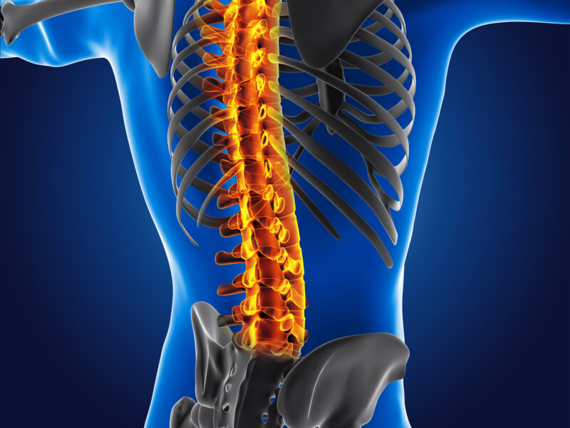 Bulging Disc Pain? Visit Dr. Sandeep Kesharwani, Spine Expert in Lucknow