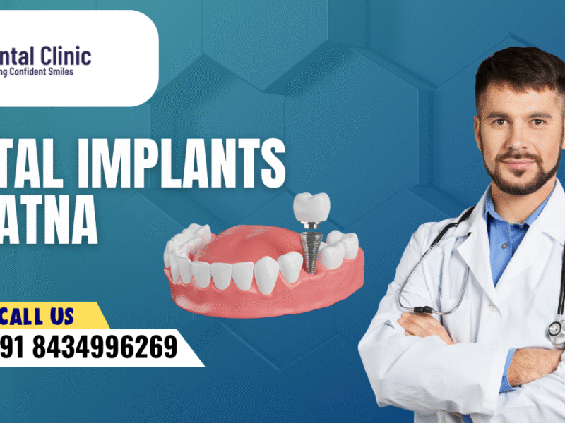 Dental Implants In Patna